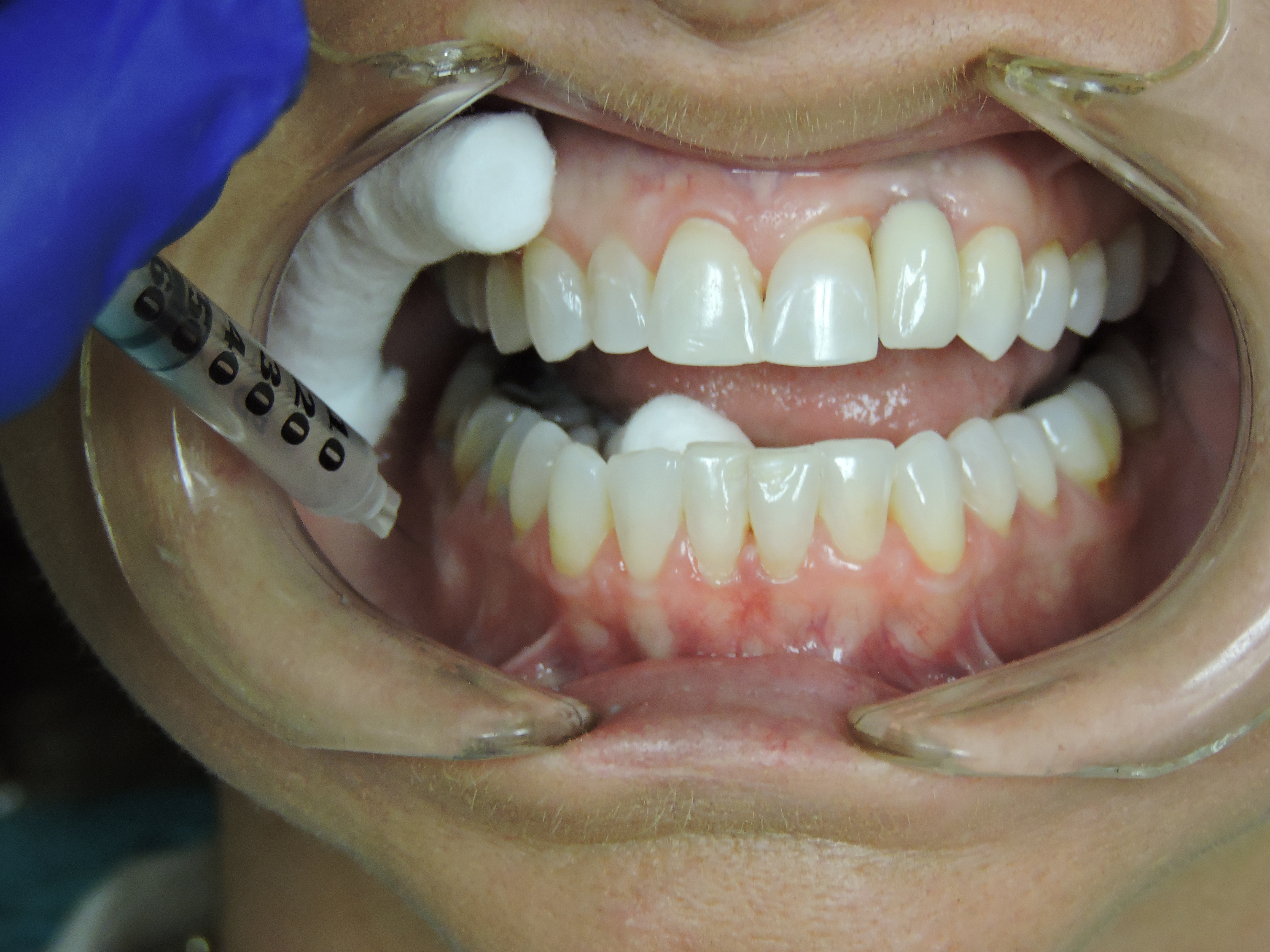 3D Exosome Injection