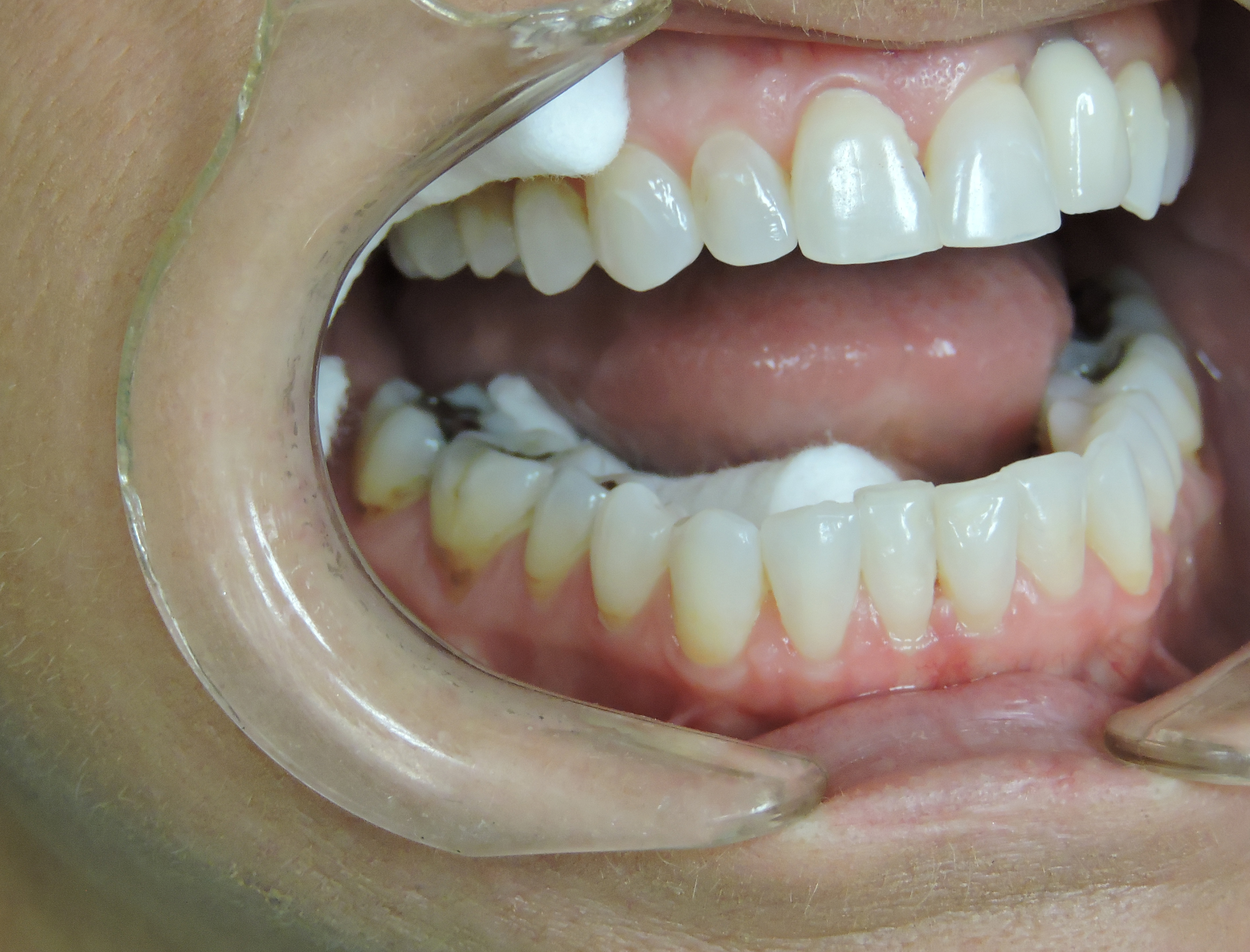 Isolation for PEM Placement