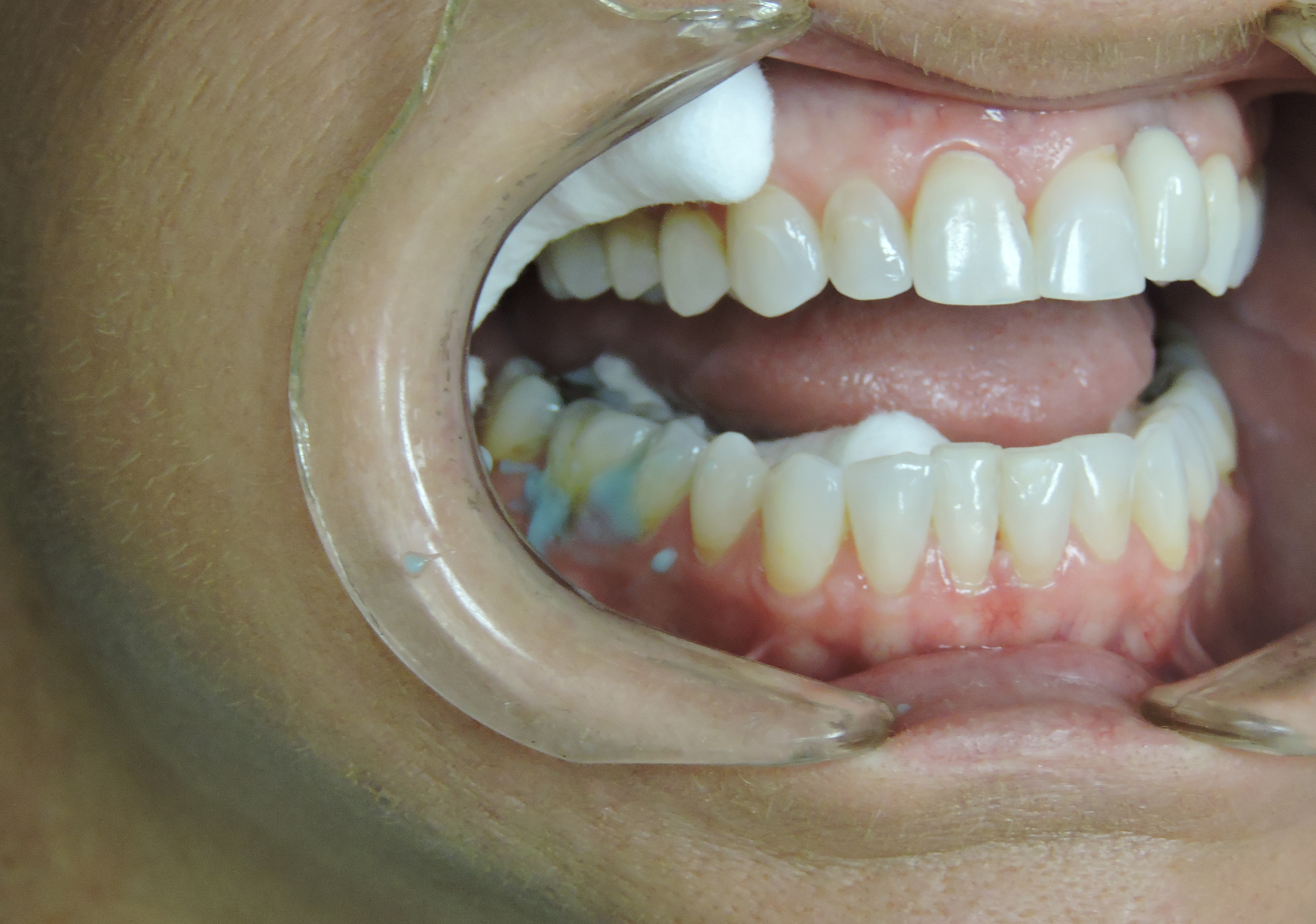 PEM pase placement in sulcus