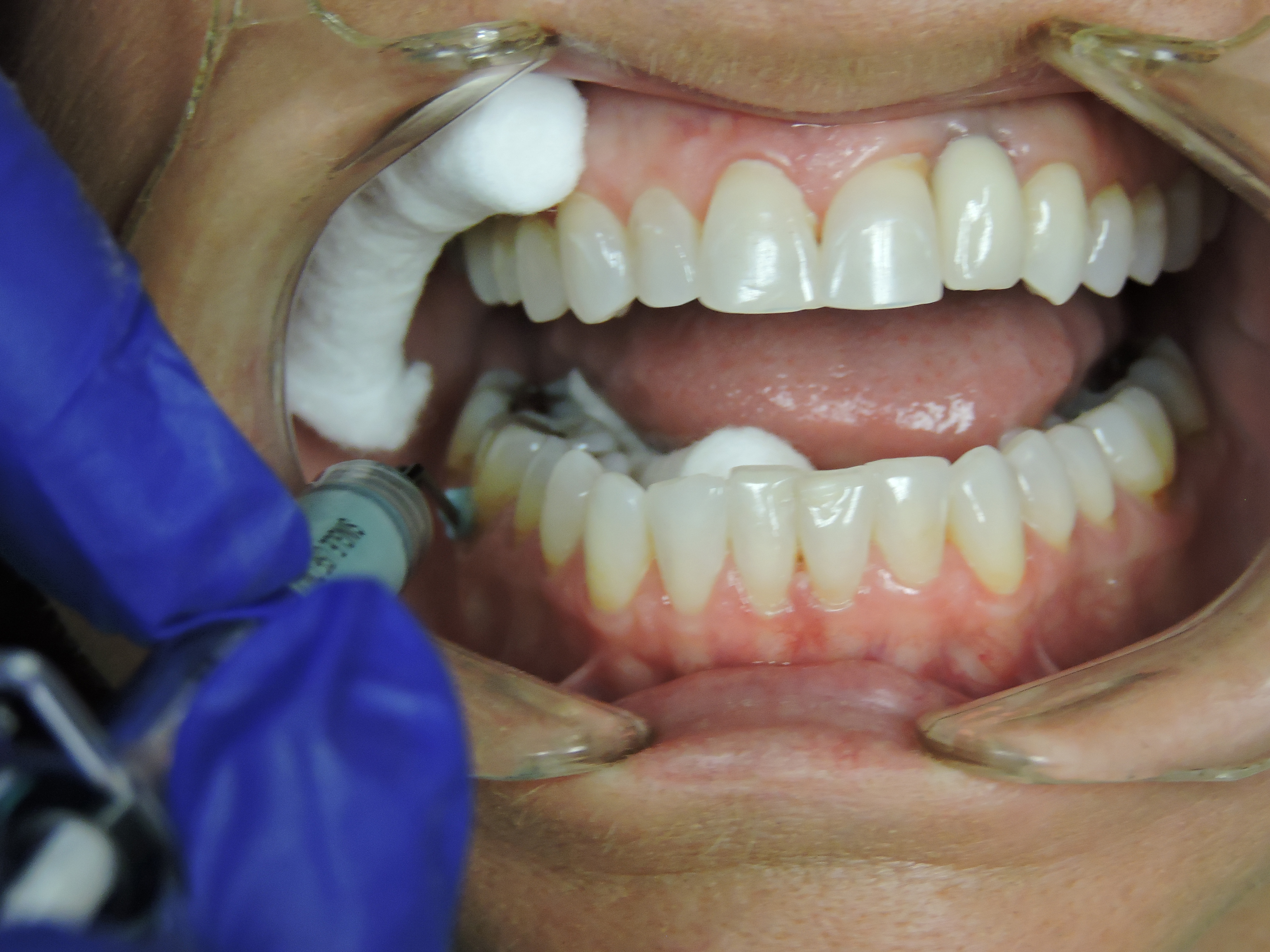 PEM paste placement in sulcus